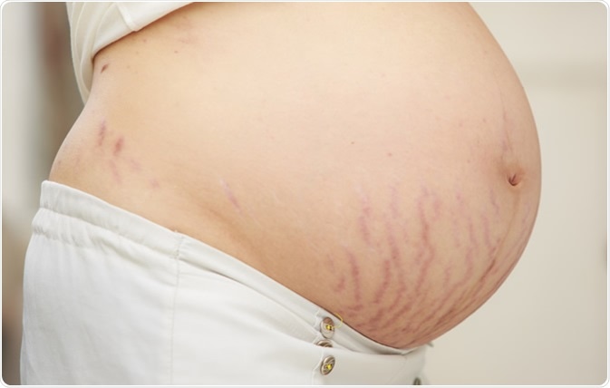 pregnant woman with stretch marks